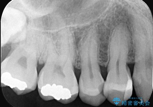 虫歯治療|歯を長持ちさせるための治療|セラッミクインレー|審美回復の治療前