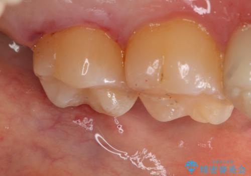 銀歯のやり変え希望 セラミックインレーの治療後