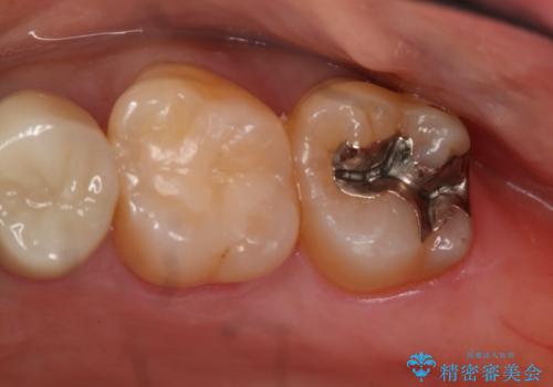 銀歯のやり変え希望 セラミックインレーの治療前