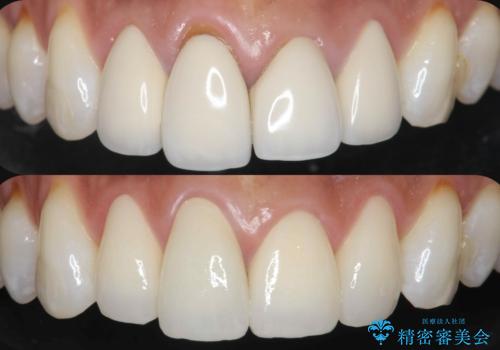金属色の見える前歯 オールセラミックで審美治療