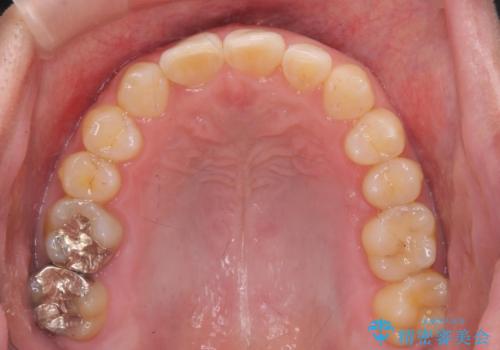 前歯のすき間 歯のがたつきの治療中