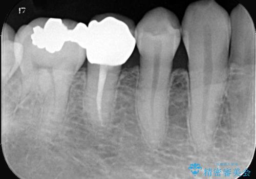 虫歯治療|歯を長持ちさせるための治療|セラミッククラウン|審美回復|精密根管治療の治療後