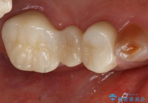 奥歯のスペースを埋めたい フルジルコニアブリッジの治療後