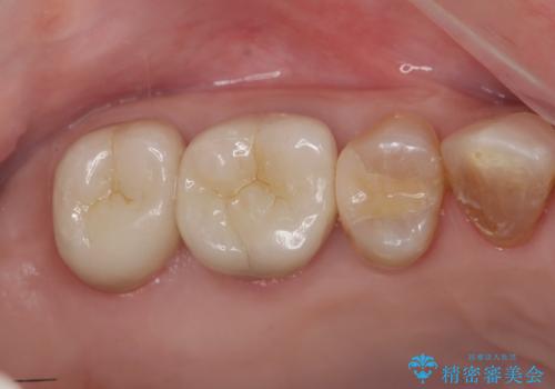 歯周ポケットの除去と再補綴治療の治療後