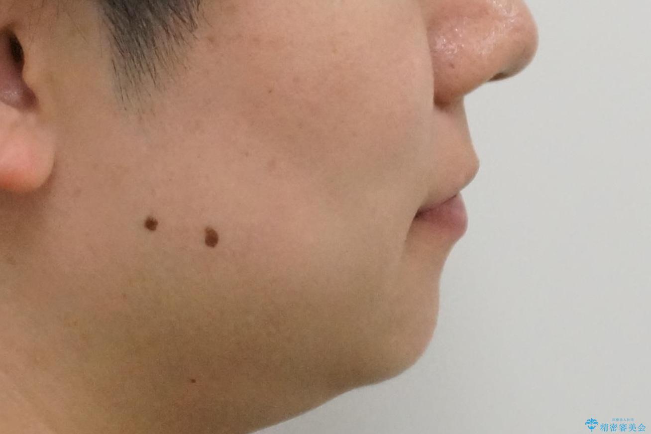 前歯のすき間 歯のがたつきの治療前(顔貌)