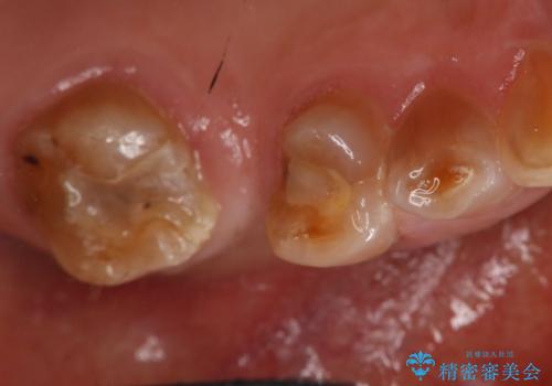 奥歯のスペースを埋めたい フルジルコニアブリッジの治療前