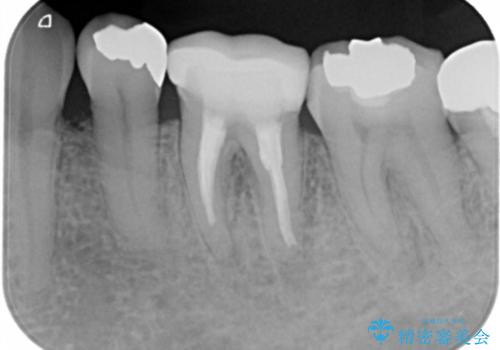 銀歯を白くしたい セラミックインレーの治療前