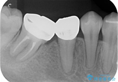 銀歯を白くしたい セラミック治療の治療前