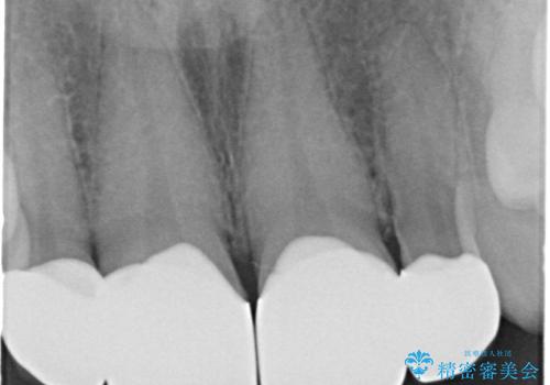前歯が大きいのが気になる セラミックで整えたいの治療後