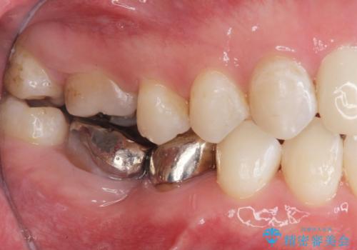 銀歯を白くしたい セラミック治療の治療前