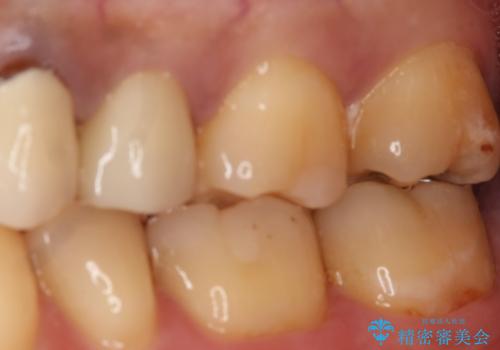 銀歯のやり変え希望 セラミックインレーの治療前