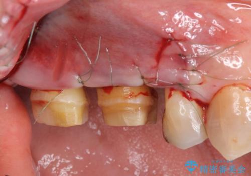 歯周ポケットの除去と再補綴治療の治療中