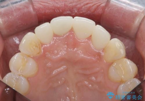 金属色の見える前歯 オールセラミックで審美治療の治療後