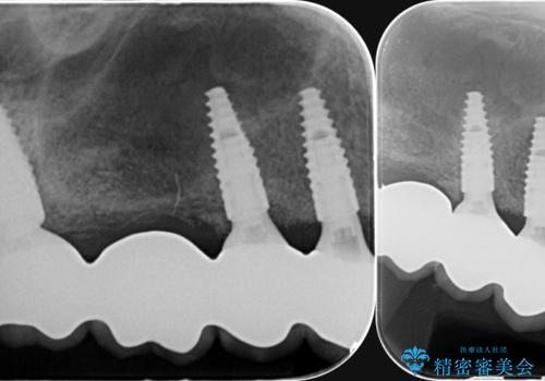 歯がずっと疼く 根本的な治療の希望の治療後
