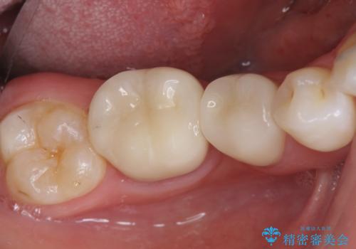 銀歯を白くしたい セラミック治療の治療後