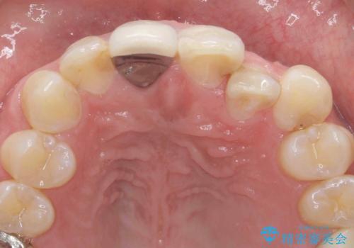 奥に引っ込んでいる前歯を並べたい 矯正治療とセラミック治療の治療前