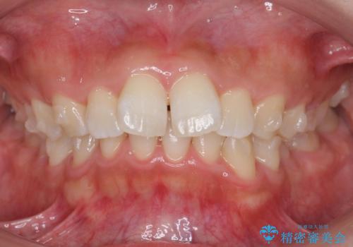 出っ歯の治療 抜かずに 短期間で目立たない治療の治療中