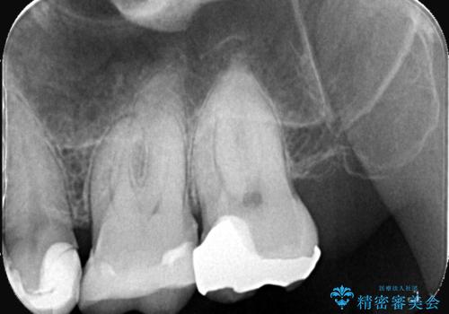 左上7のメタルインレーを除去|セラミッククラウンで自然な美しさと機能回復の治療前