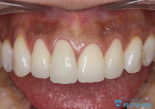金属色の見える前歯 オールセラミックで審美治療の治療後