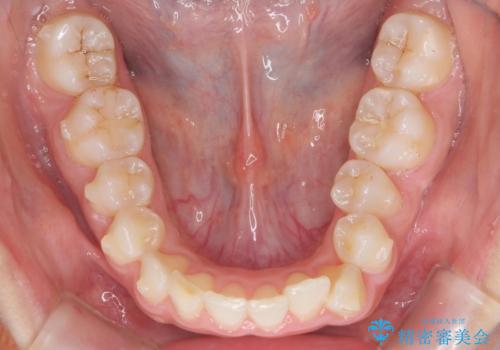 出っ歯の治療 抜かずに 短期間で目立たない治療の治療中