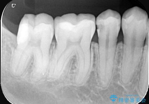 見落としやすい虫歯(コンタクトカリエス)を発見|精密診断で早期治療の治療前