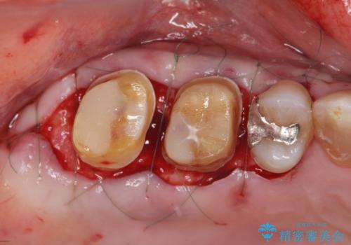 歯周ポケットの除去と再補綴治療の治療中