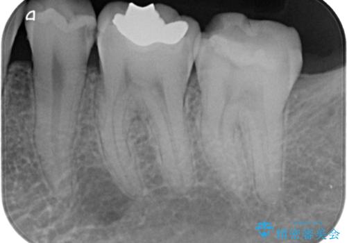 詰め物が欠けて虫歯になってる気がする セラミックインレー修復の治療前