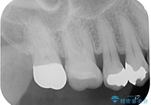 詰め物が欠けた ハイブリッドインレー修復の治療後