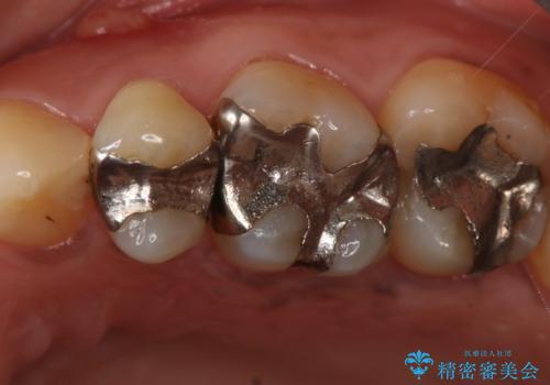 歯ぐきが腫れた フルジルコニアクラウンの症例 治療前