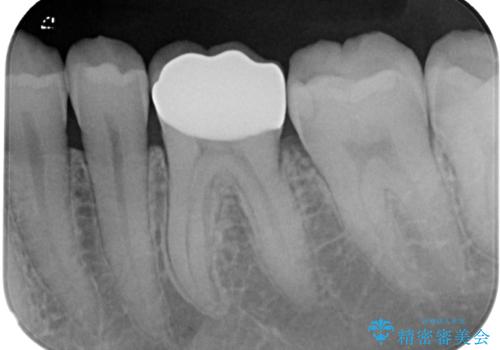 詰め物が割れたのでやり替えたい オールセラミッククラウンの治療後