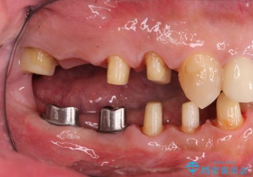 多数の銀歯と虫歯、セラミック・インプラント治療の治療中