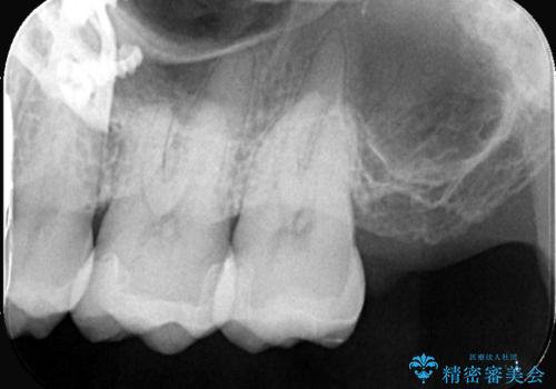 【セラミックインレー】虫歯がないか確認してほしいの治療後