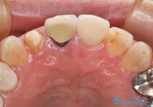 前歯を綺麗にしたい オールセラミッククラウンの治療中