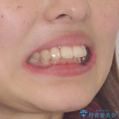 飛び出した前歯 抜歯矯正で横顔が劇的変化の治療前(顔貌)