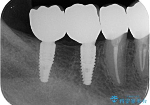 多数の銀歯と虫歯、セラミック・インプラント治療の治療後