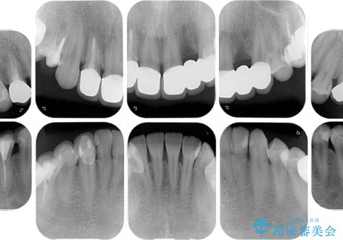 以前の治療箇所が痛む 全顎的なむし歯治療の治療後