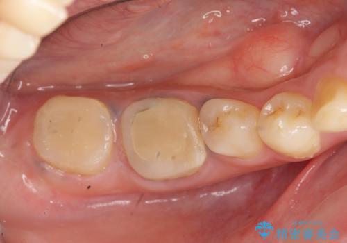 歯冠長延長術・骨隆起除去を行った、スペースの少ないセラミック治療の治療前