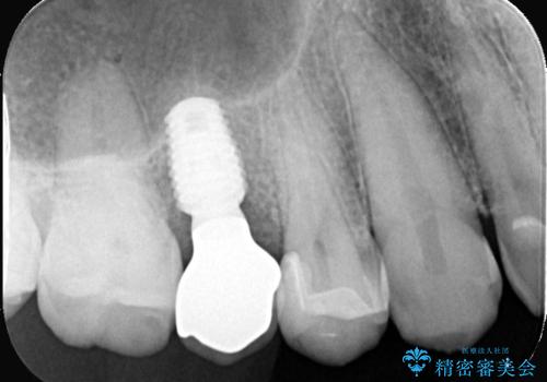 低侵襲なインプラント|痛くないインプラント|エンドペリオ病変|虫歯治療|セラッミクインレーの治療後