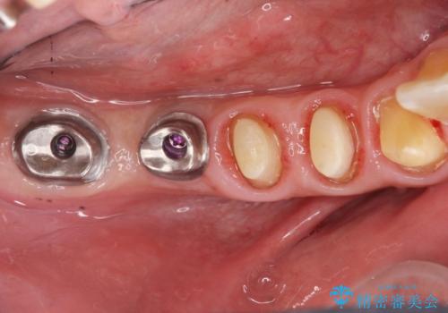 多数の銀歯と虫歯、セラミック・インプラント治療の治療中