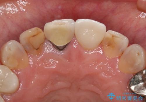 前歯を綺麗にしたい オールセラミッククラウンの治療前