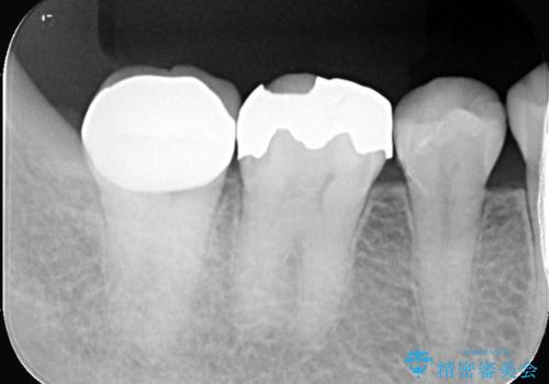 銀歯の下の虫歯|オールセラミッククラウン|歯を長持ちさせるための治療|歯の神経を守るの治療後