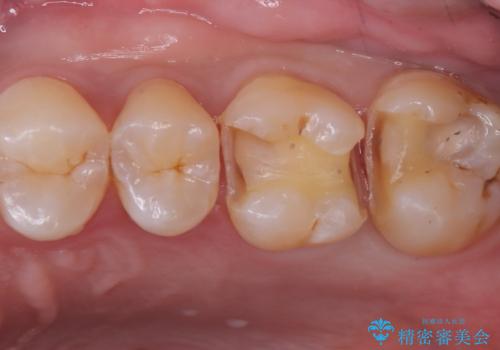 【セラミックインレー】虫歯がないか確認してほしいの治療中