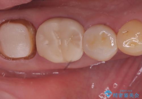 【セラミッククラウン】銀歯を白くしたいの治療中