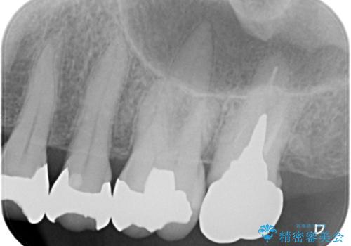 被せものに穴が開いたのでやり替えたい オールセラミッククラウンの治療前