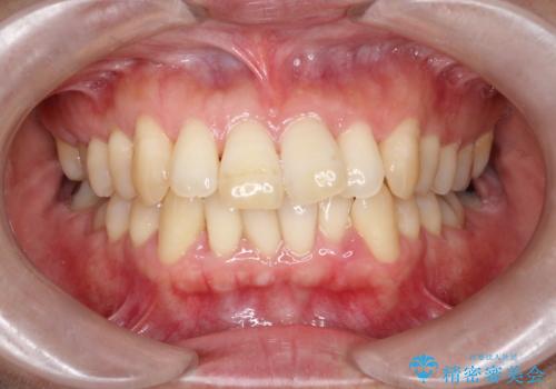 抜歯を伴う審美ワイヤー矯正の治療前