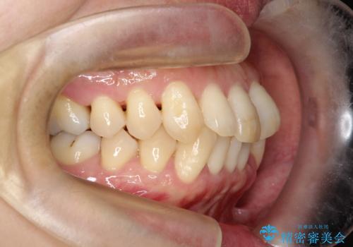 抜歯を伴う審美ワイヤー矯正の治療前