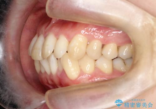 抜歯を伴う審美ワイヤー矯正の治療前