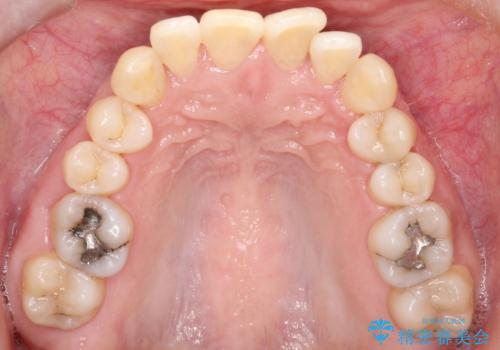 抜歯を伴う審美ワイヤー矯正の治療前