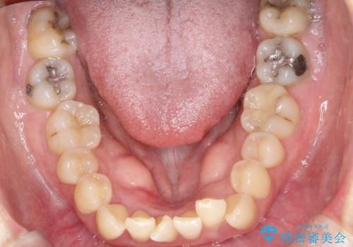 抜歯を伴う審美ワイヤー矯正の治療前