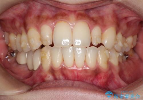 矮小歯を伴う叢生を審美的に改善|インビザライン矯正+セラミッククラウン修復の治療中